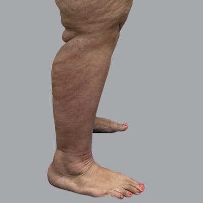 Lipedema Before & After Gallery - Patient 319353 - Image 6
