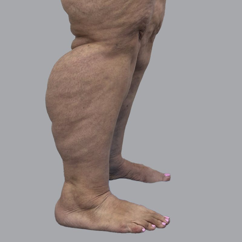 Lipedema Before & After Gallery - Patient 319353 - Image 5