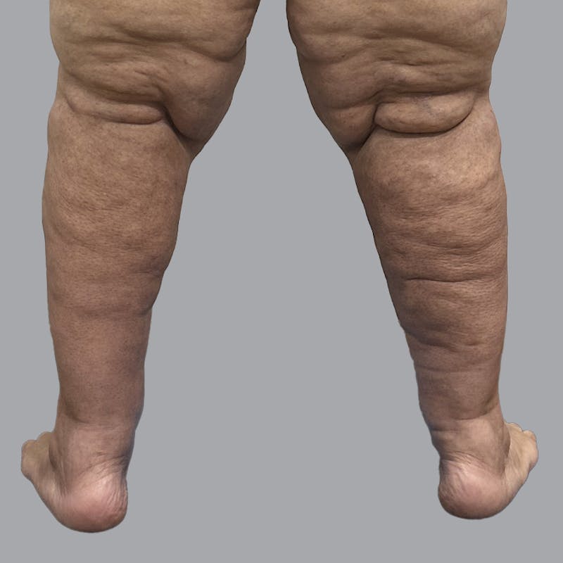 Lipedema Before & After Gallery - Patient 319353 - Image 2
