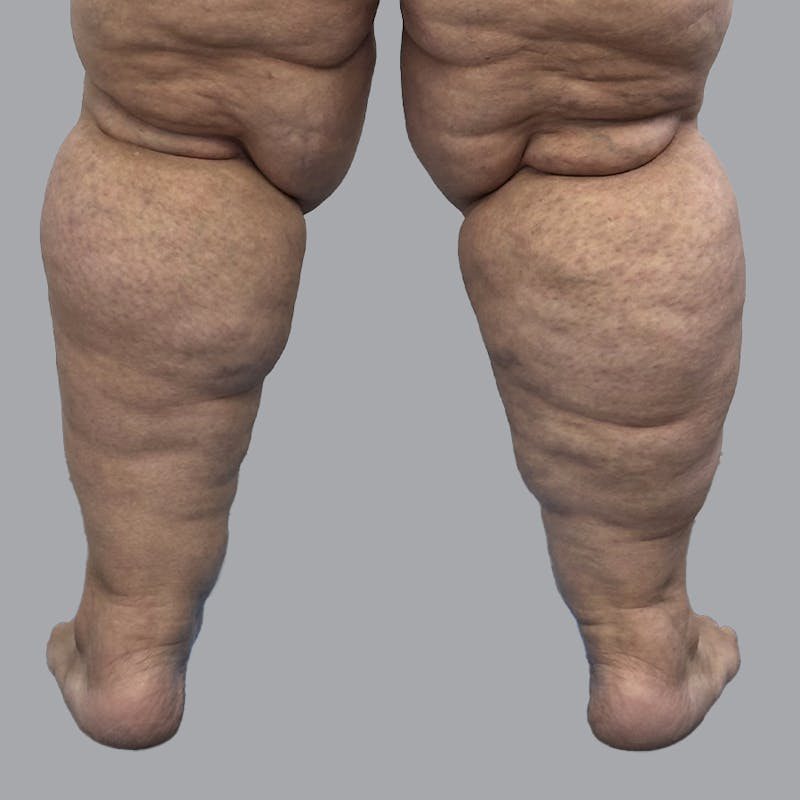 Lipedema Before & After Gallery - Patient 319353 - Image 1