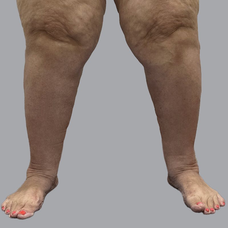 Lipedema Before & After Gallery - Patient 319353 - Image 8