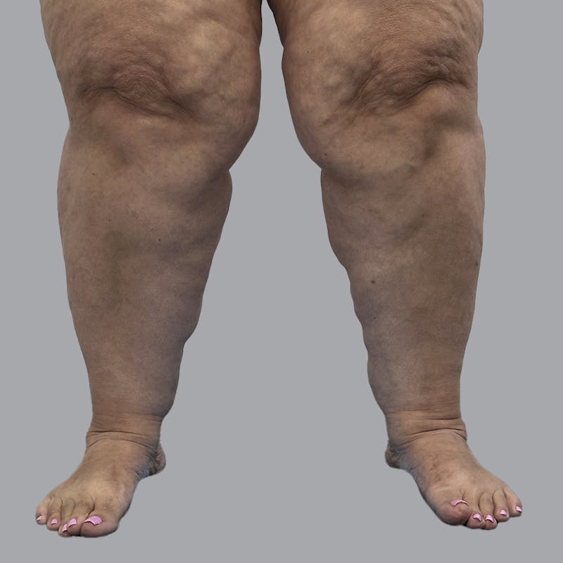 Lipedema Before & After Gallery - Patient 319353 - Image 7