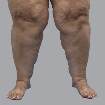 Lipedema Before & After Gallery - Patient 319353 - Image 7