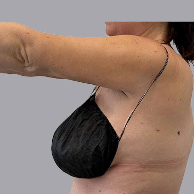 Arm Liposuction Before & After Gallery - Patient 117028 - Image 6