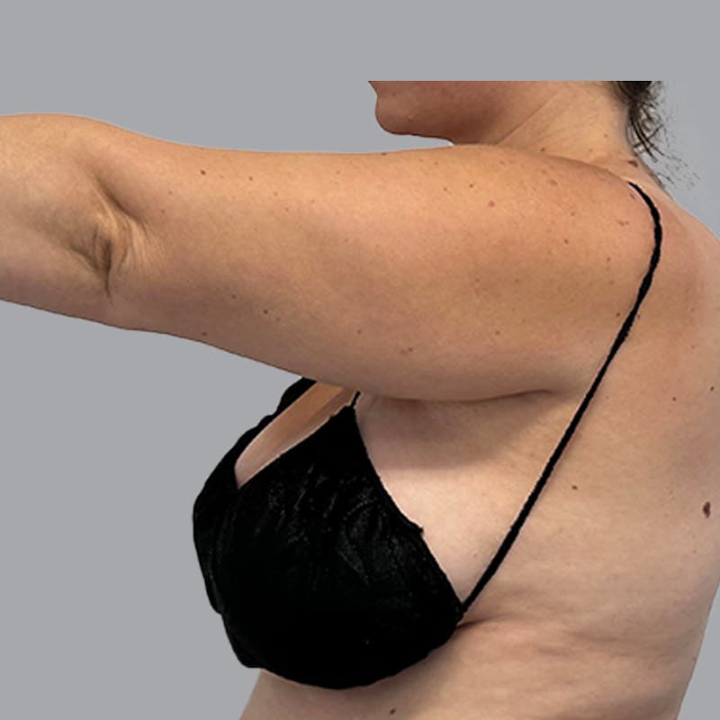 Arm Liposuction Before & After Gallery - Patient 117028 - Image 5