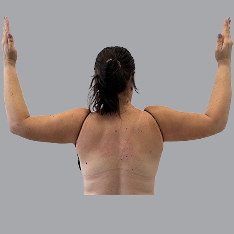 Arm Liposuction Before & After Gallery - Patient 117028 - Image 2