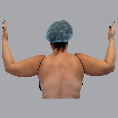 Lipedema Before & After Gallery - Patient 164117 - Image 1