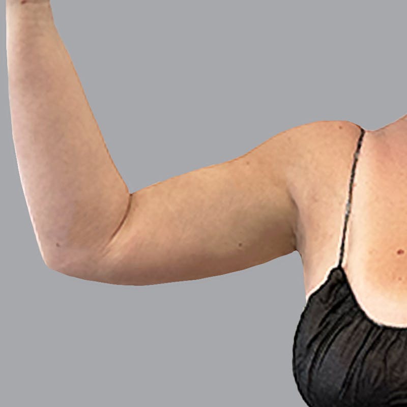 Arm Liposuction Before & After Gallery - Patient 117028 - Image 4