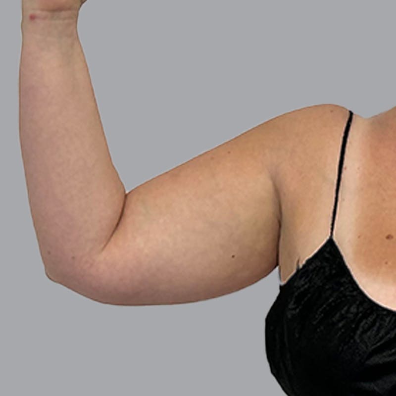 Arm Liposuction Before & After Gallery - Patient 117028 - Image 3
