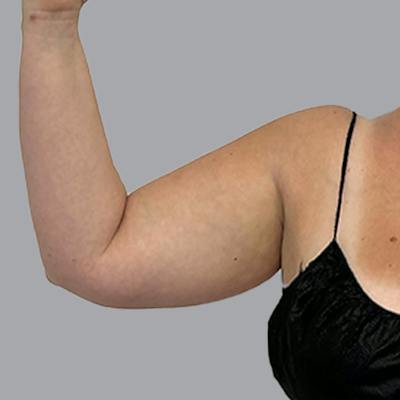 Lipedema Before & After Gallery - Patient 164117 - Image 3