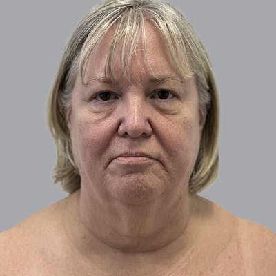 Facelift and Neck Lift Before & After Gallery - Patient 195569 - Image 1