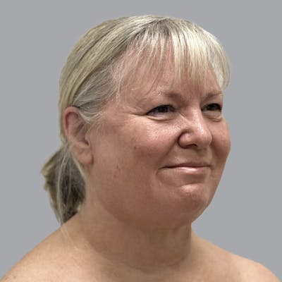 Facelift and Neck Lift Before & After Gallery - Patient 195569 - Image 4