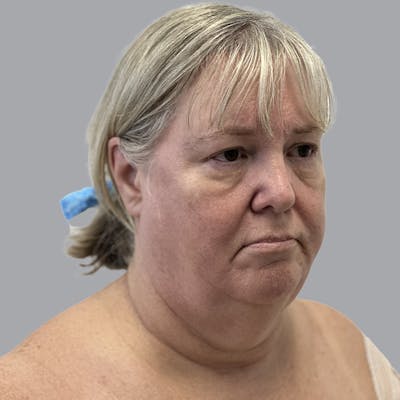 Facelift and Neck Lift Before & After Gallery - Patient 195569 - Image 3