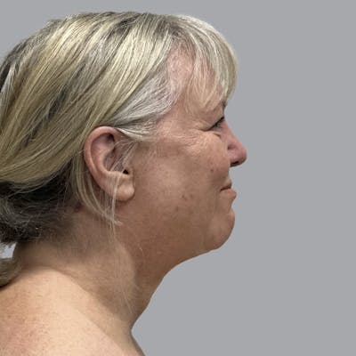 Facelift and Neck Lift Before & After Gallery - Patient 195569 - Image 6