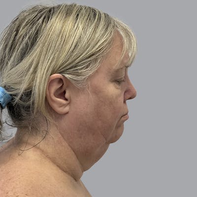 Facelift and Neck Lift Before & After Gallery - Patient 195569 - Image 5