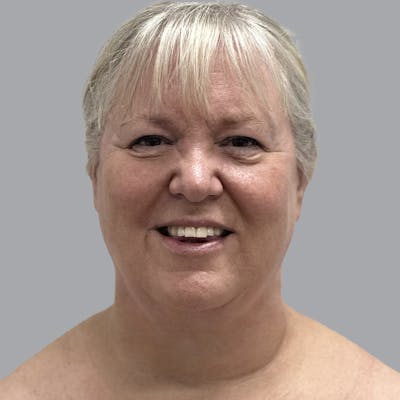Facelift and Neck Lift Before & After Gallery - Patient 195569 - Image 2