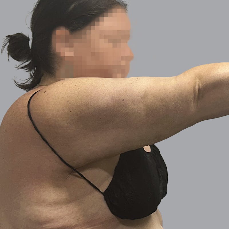 Arm Liposuction Before & After Gallery - Patient 367581 - Image 4