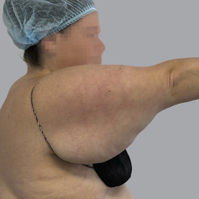 Lipedema Before & After Gallery - Patient 539883 - Image 5