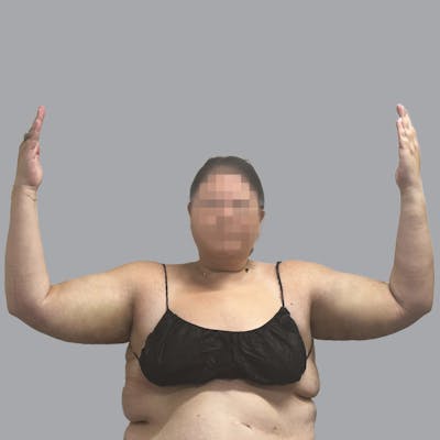 Lipedema Before & After Gallery - Patient 539883 - Image 2