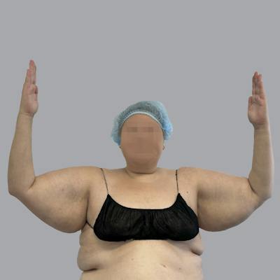 Lipedema Before & After Gallery - Patient 539883 - Image 1