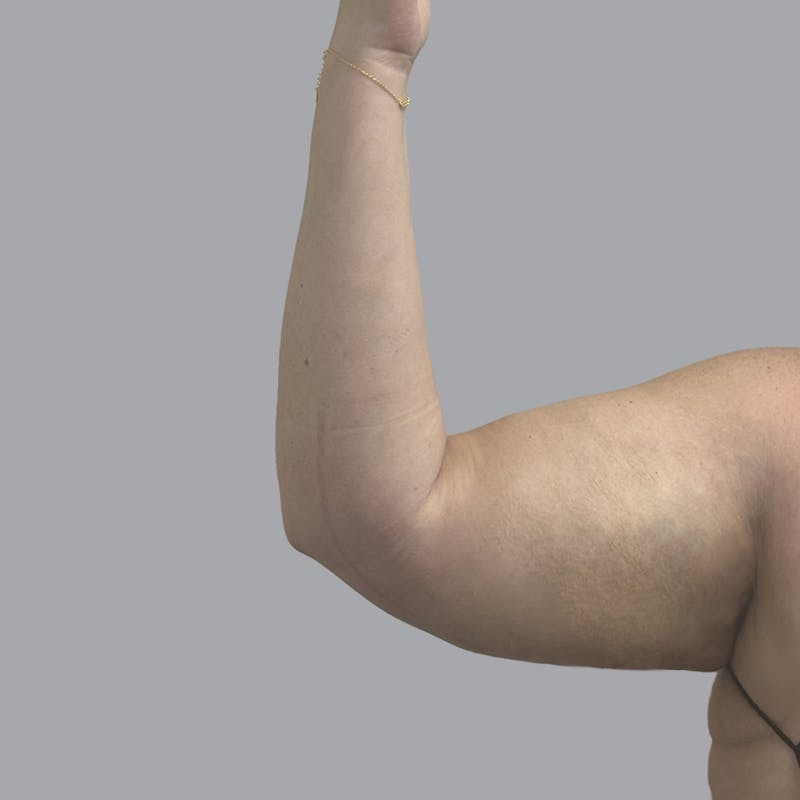 Arm Liposuction Before & After Gallery - Patient 367581 - Image 6