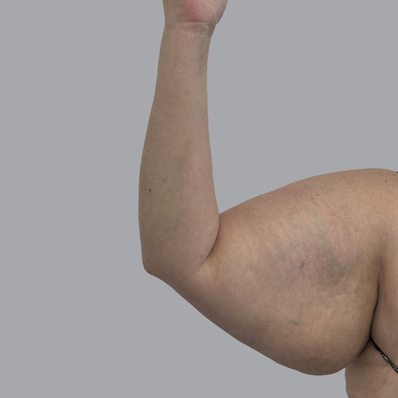 Arm Liposuction Before & After Gallery - Patient 367581 - Image 5
