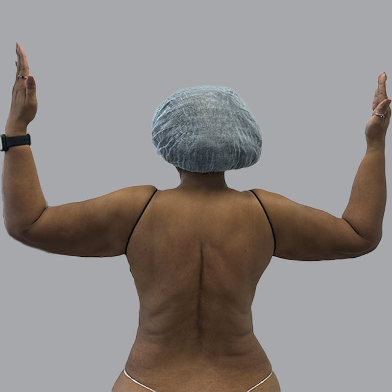 Lipedema Before & After Gallery - Patient 251814 - Image 2
