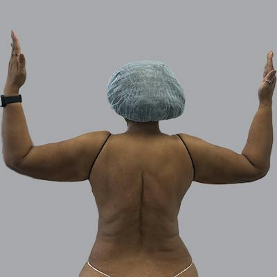 Lipedema Before & After Gallery - Patient 251814 - Image 2