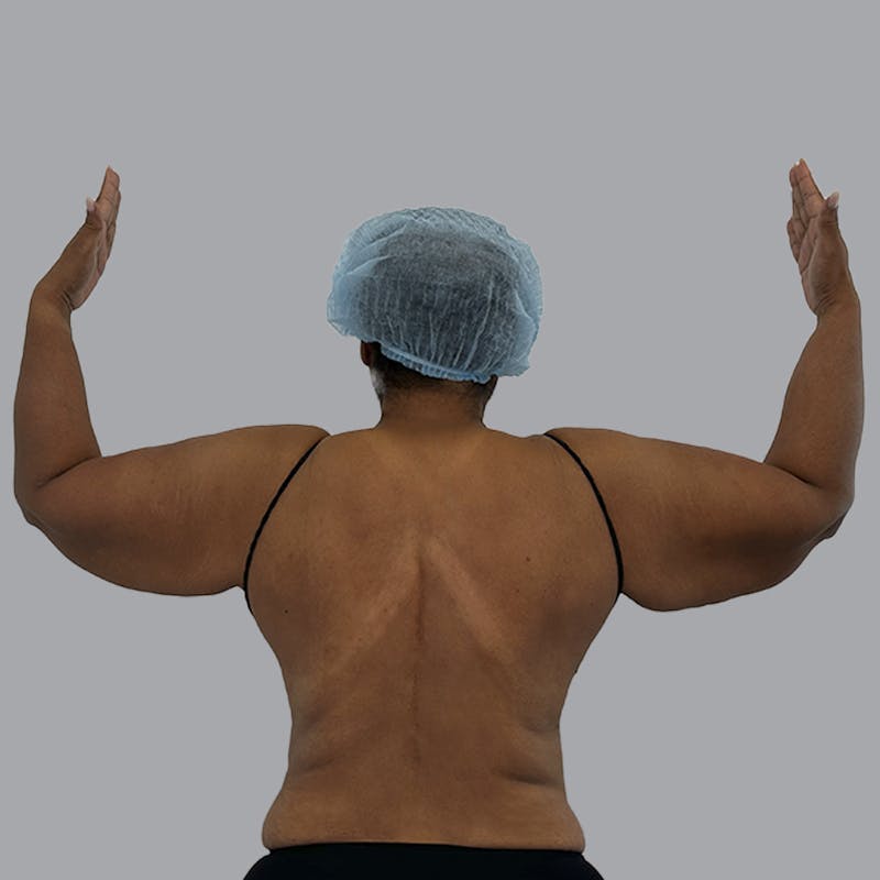 Lipedema Before & After Gallery - Patient 251814 - Image 1