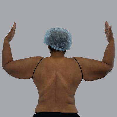 Lipedema Before & After Gallery - Patient 251814 - Image 1