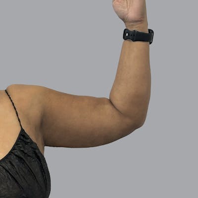 Lipedema Before & After Gallery - Patient 251814 - Image 6
