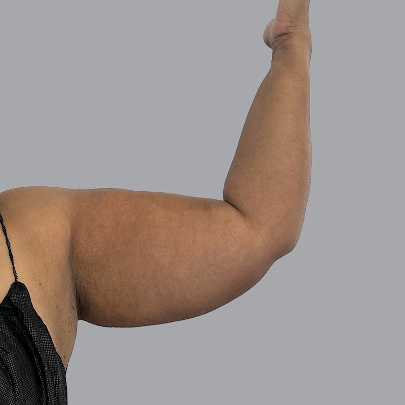 Lipedema Before & After Gallery - Patient 251814 - Image 5