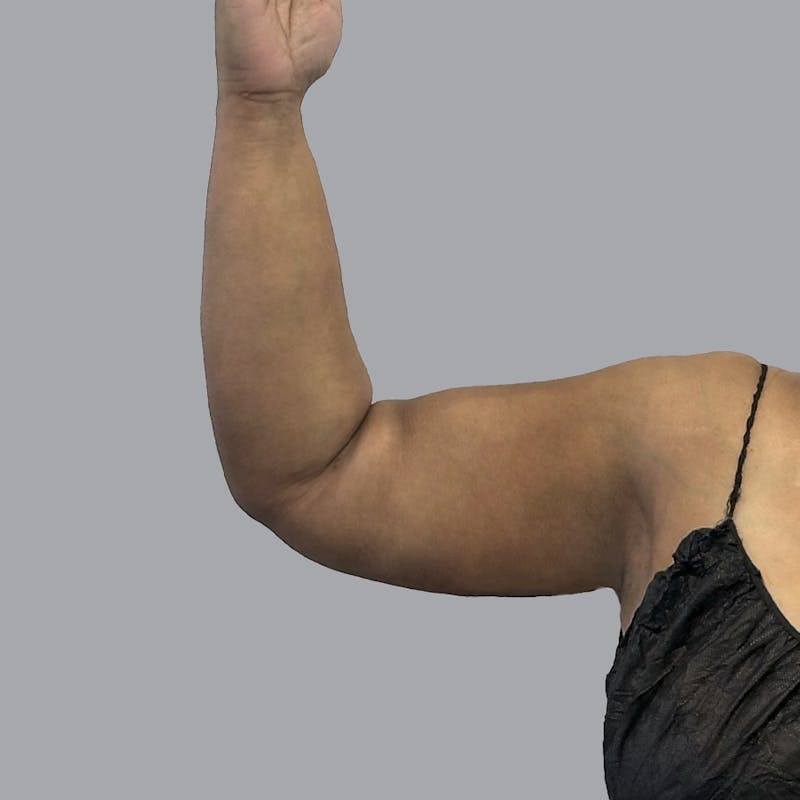 Lipedema Before & After Gallery - Patient 251814 - Image 4