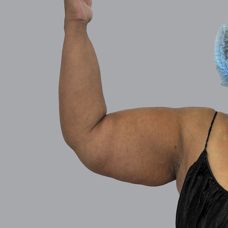 Lipedema Before & After Gallery - Patient 251814 - Image 3