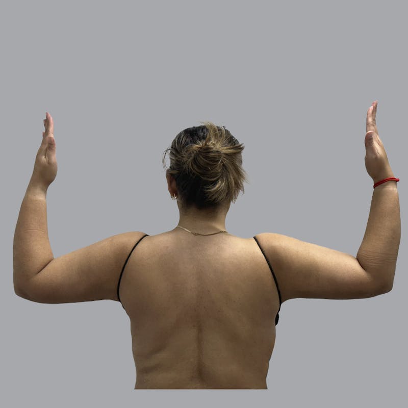 Arm Liposuction Before & After Gallery - Patient 126639 - Image 2