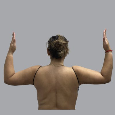 Lipedema Before & After Gallery - Patient 168677 - Image 2