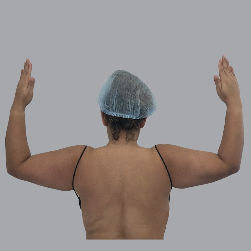 Arm Liposuction Before & After Gallery - Patient 126639 - Image 1
