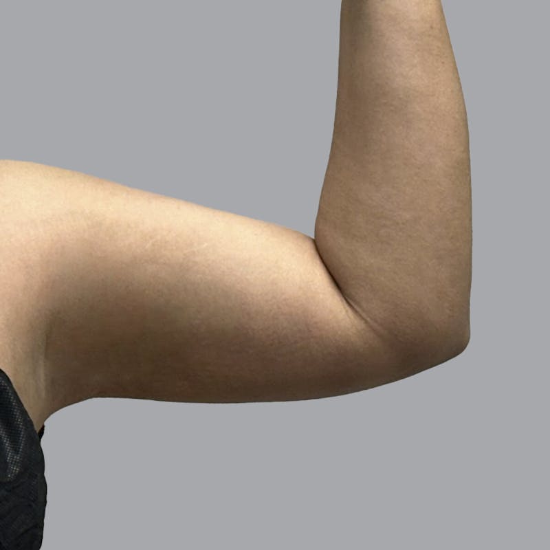 Arm Liposuction Before & After Gallery - Patient 126639 - Image 4