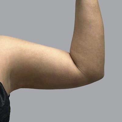 Lipedema Before & After Gallery - Patient 168677 - Image 6