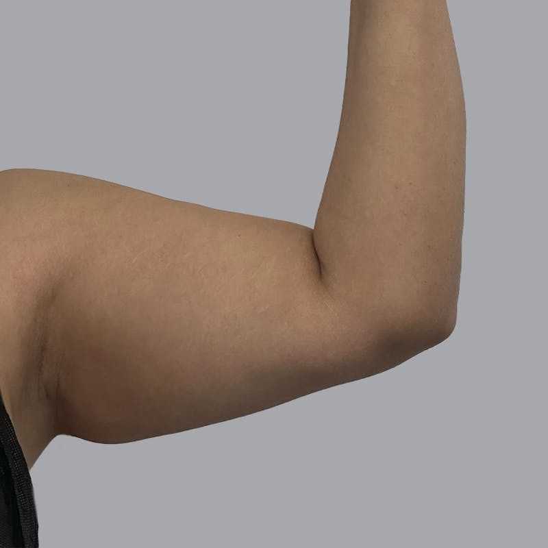 Arm Liposuction Before & After Gallery - Patient 126639 - Image 3