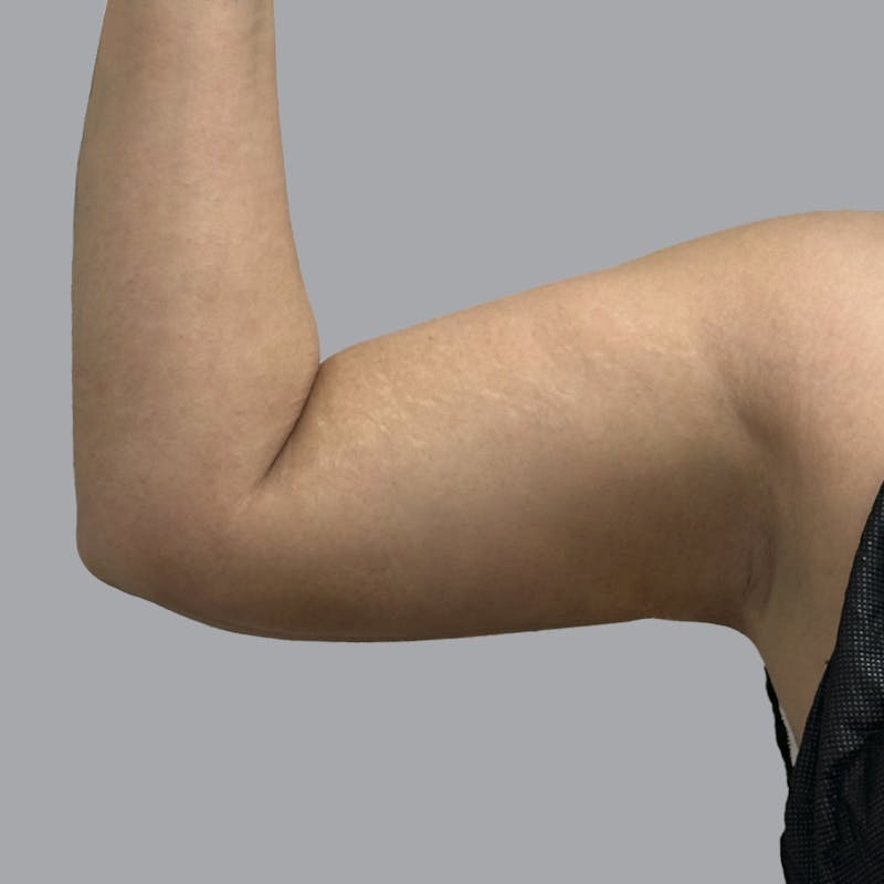 Arm Liposuction Before & After Gallery - Patient 126639 - Image 6