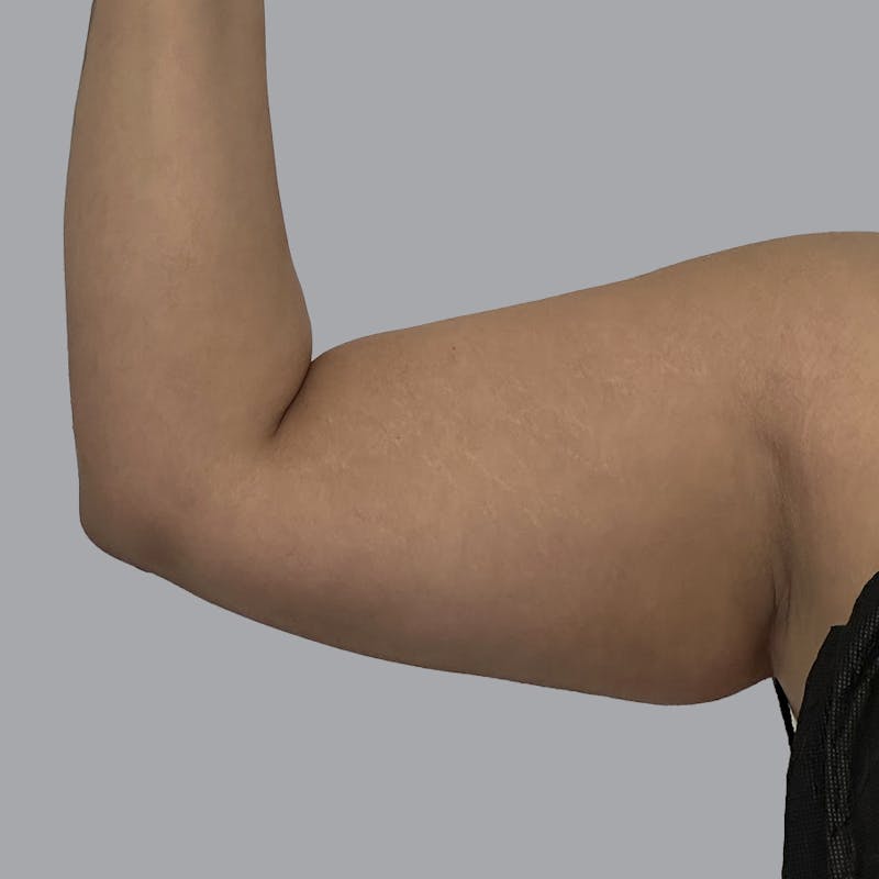 Arm Liposuction Before & After Gallery - Patient 126639 - Image 5
