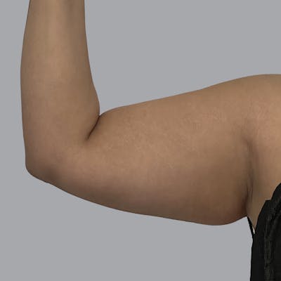 Lipedema Before & After Gallery - Patient 168677 - Image 3