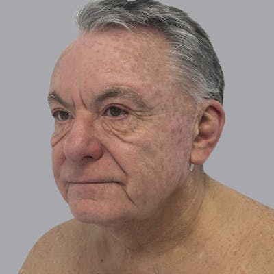 Facelift and Neck Lift Before & After Gallery - Patient 243411 - Image 3