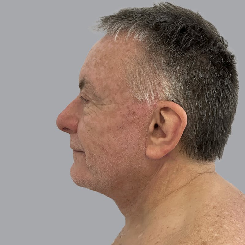Facelift and Neck Lift Before & After Gallery - Patient 243411 - Image 6