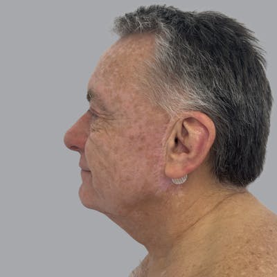 Facelift and Neck Lift Before & After Gallery - Patient 243411 - Image 5