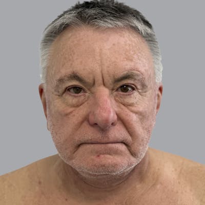 Facelift and Neck Lift Before & After Gallery - Patient 243411 - Image 2