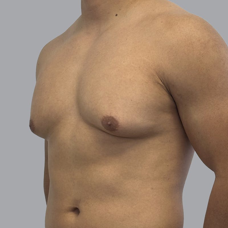 Gynecomastia Before & After Gallery - Patient 380227 - Image 5