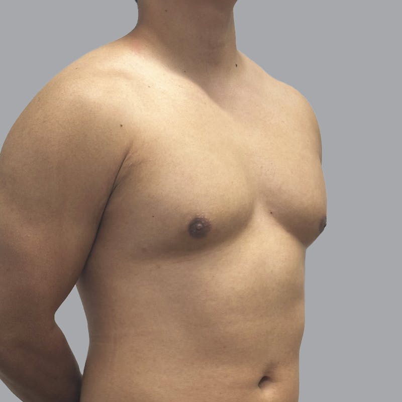 Gynecomastia Before & After Gallery - Patient 380227 - Image 4