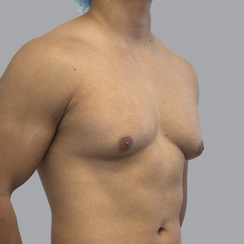 Gynecomastia Before & After Gallery - Patient 380227 - Image 3